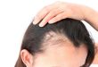 Cara Alami Mengatasi Rambut Rontok yang Ampuh dan Mudah