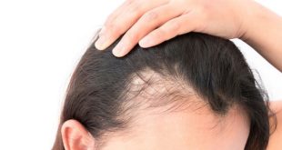 Cara Alami Mengatasi Rambut Rontok yang Ampuh dan Mudah