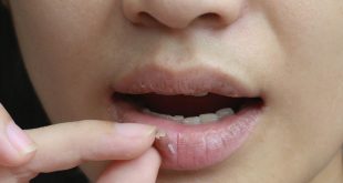 Cara Mengatasi Bibir Kering : Rahasia untuk Senyum Menawan
