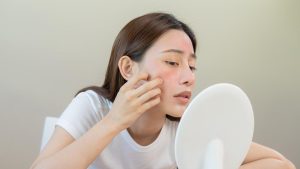 Cara Mengatasi Eksim dengan Mudah dan Cepat Mengubah Gaya Hidup
