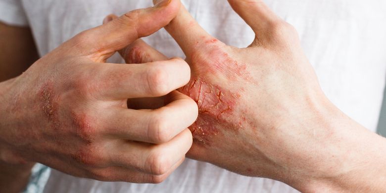 Cara Mengatasi Eksim dengan Mudah dan Cepat Cara Mengatasi Eksim dengan Mudah dan Cepat