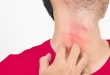 Cara Ampuh Mengatasi Alergi Dingin
