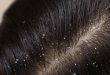 Cara Mengatasi Ketombe dan Rambut Rontok
