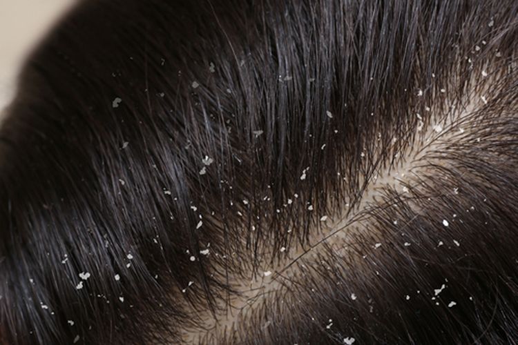 Cara Mengatasi Ketombe dan Rambut Rontok Cara Mengatasi Ketombe dan Rambut Rontok