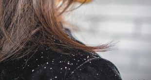 Tips Mengurangi Ketombe Pada Rambut dengan Cepat dan Mudah
